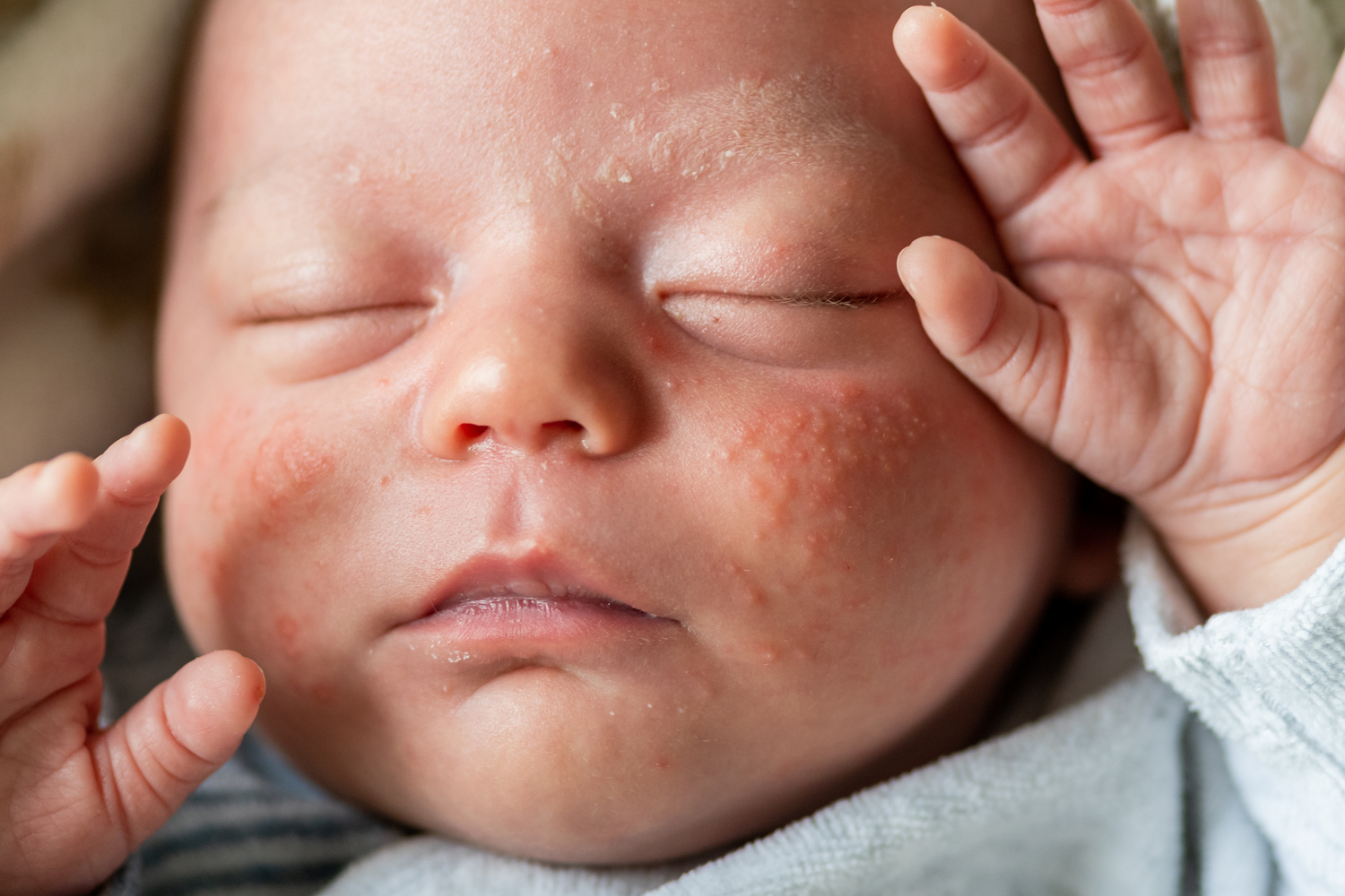 web Kruiden optillen Baby acne: wat is het en wat kan je eraan doen? | Bloom of life